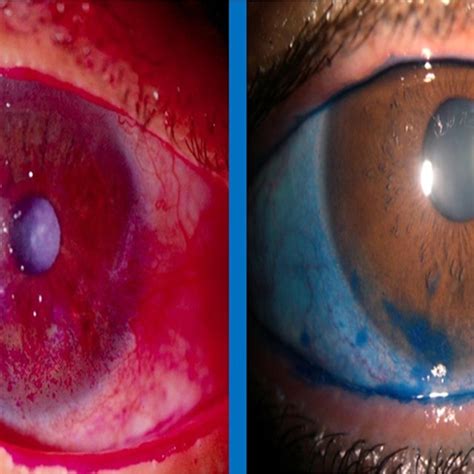 tear ferning test|lissamine green staining dry eye.